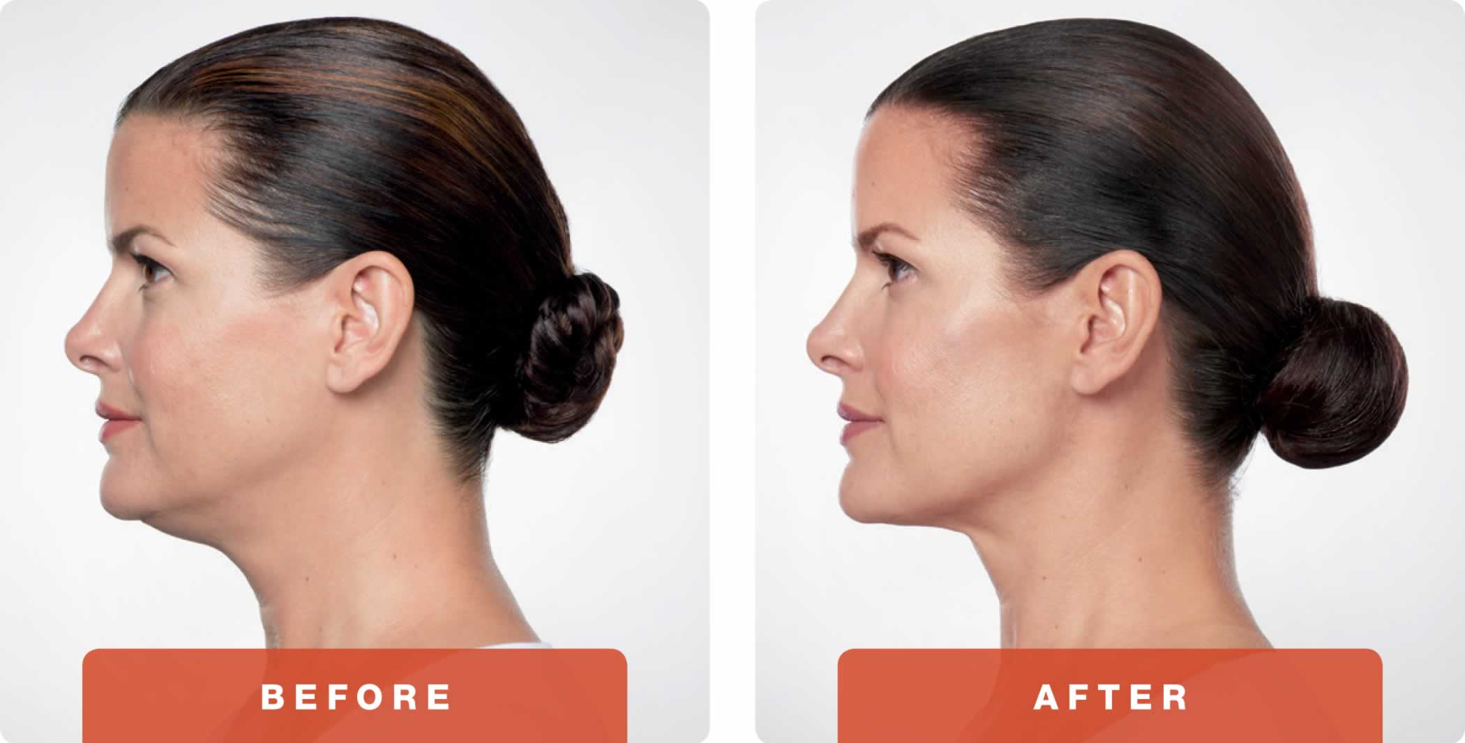 Kybella double chin before and after